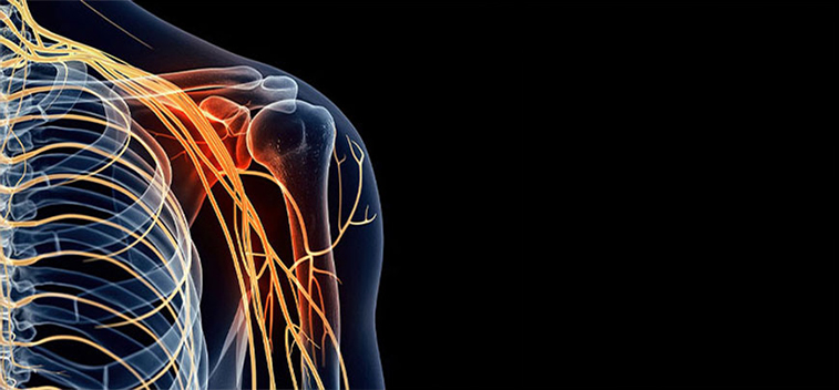 patient experiencing Brachial Plexus Neuropathy and in need of the neuropathy treatment protocol at Pittsburgh East Health Center in Monroeville