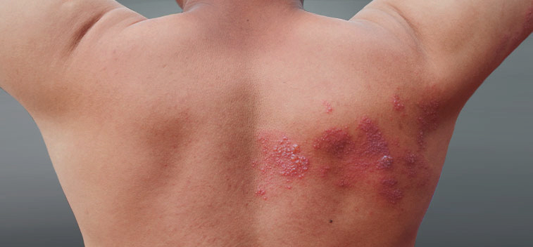 patient experiencing Post-Herpetic Neuralgia and in need of the neuropathy treatment protocol at Pittsburgh East Health Center in Monroeville